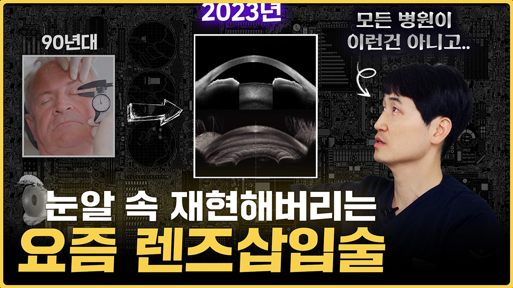 렌즈삽입술 처음엔 자📏로 눈을 재서 넣었다 🧐 #렌즈삽입술의 역사